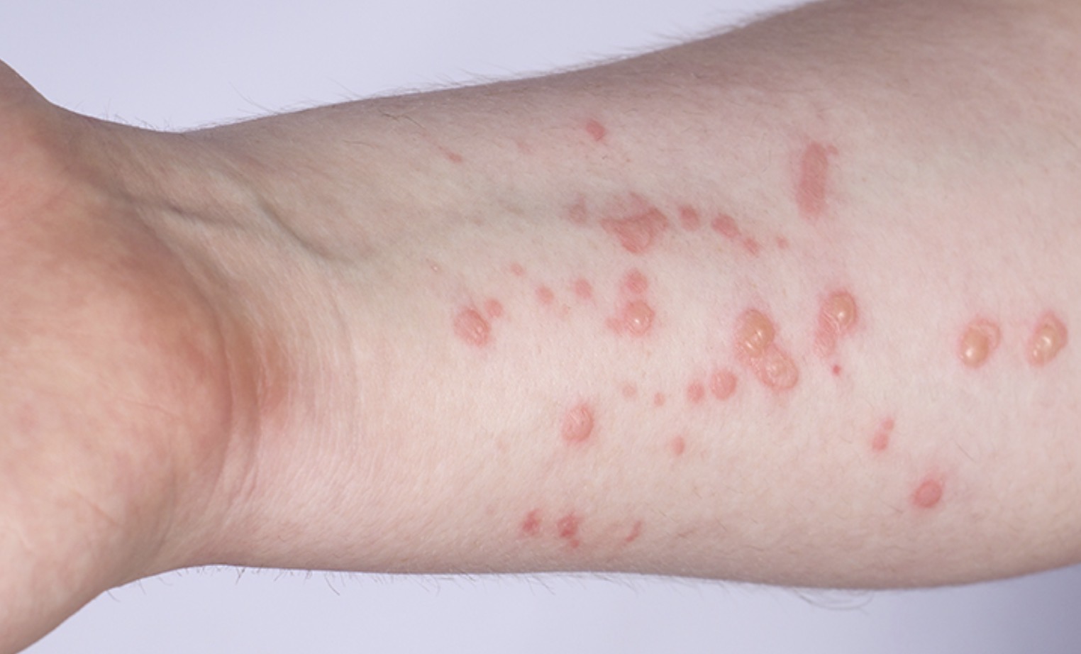 Confirmaron en Argentina caso de variante contagiosa de viruela del mono