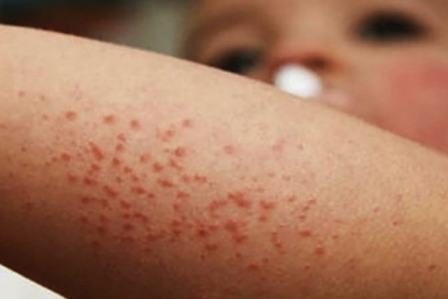 Activan en Entre Ríos protocolo sanitario por otro posible caso de sarampión