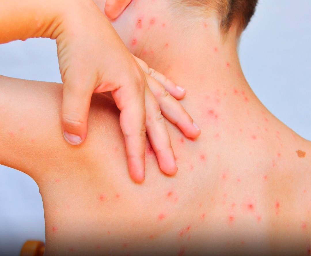 Salud alerta por baja cobertura de vacunación contra la varicela