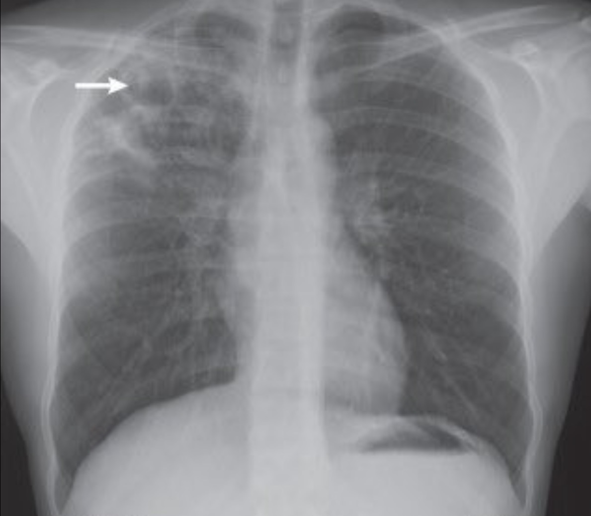 Aumentaron los casos de tuberculosis