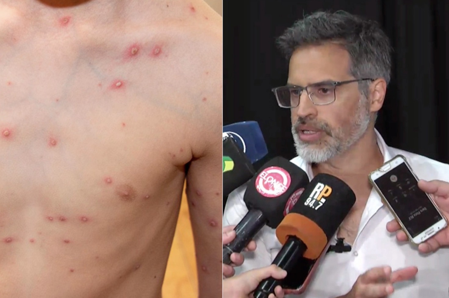 Hay un brote de varicela en Entre Ríos