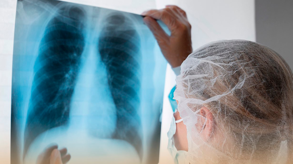 Intensifican acciones de vigilancia ante el aumento de casos de tuberculosis